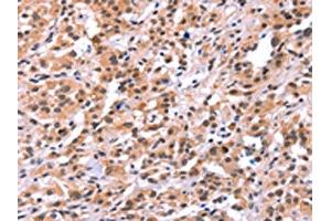 The image on the left is immunohistochemistry of paraffin-embedded Human thyroid cancer tissue using ABIN7191561(MYF5 Antibody) at dilution 1/15, on the right is treated with synthetic peptide. (MYF5 antibody)