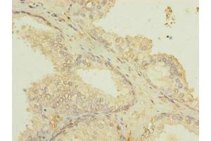 Immunohistochemistry of paraffin-embedded human prostate cancer using ABIN7151502 at dilution of 1:100 (ETFDH antibody  (AA 34-617))
