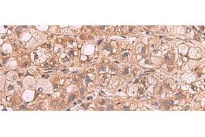 Immunohistochemistry of paraffin-embedded Human liver cancer tissue using PPP2R1A Polyclonal Antibody at dilution of 1:65(x200) (PPP2R1A antibody)