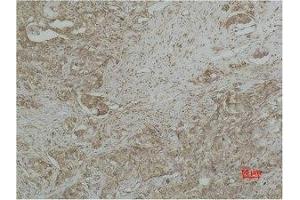 Immunohistochemical analysis of paraffin-embedded human Breast caricnoma using CYCS Monoclonal Antibody. (Cytochrome C antibody)