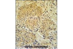 IPO7 Antibody (N-term) (ABIN651626 and ABIN2840333) immunohistochemistry analysis in formalin fixed and paraffin embedded human cervix carcinoma followed by peroxidase conjugation of the secondary antibody and DAB staining. (IPO7 antibody  (N-Term))