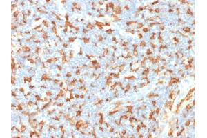 Formalin-fixed, paraffin-embedded human Lymph Node stained with AIF1 / Iba1 Mouse Monoclonal Antibody (AIF1/1909).