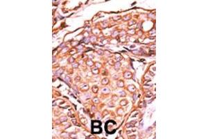 Formalin-fixed and paraffin-embedded human cancer tissue reacted with the primary antibody, which was peroxidase-conjugated to the secondary antibody, followed by AEC staining. (C-JUN antibody  (pSer63))
