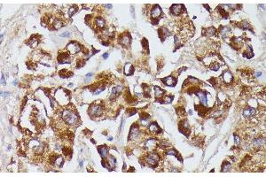Immunohistochemistry of paraffin-embedded Human liver cancer using AGT Polyclonal Antibody at dilution of 1:100 (40x lens). (AGT antibody)