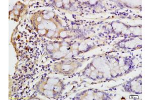 Formalin-fixed and paraffin embedded human colon carcinoma labeled with Anti-Clathrin heavy chain Polyclonal Antibody, Unconjugated (ABIN681883) at 1:200 followed by conjugation to the secondary antibody and DAB staining (Clathrin Heavy Chain (CLTC) (AA 401-500) antibody)