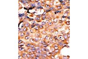 Formalin-fixed and paraffin-embedded human cancer tissue reacted with the primary antibody, which was peroxidase-conjugated to the secondary antibody, followed by AEC staining. (PANK3 antibody  (Middle Region))
