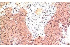 Immunohistochemistry of paraffin-embedded Human colon carcinoma tissue using Epsilon Tubulin Monoclonal Antibody at dilution of 1:200. (TUBE1 antibody)