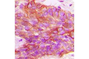 Immunohistochemical analysis of PTTG1IP staining in human breast cancer formalin fixed paraffin embedded tissue section. (PTTG1IP antibody  (Center))