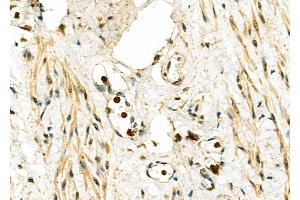 ABIN6262568 and ABIN6276793 at 1/100 staining Human ovarian cancer and adjacent normal tissues by IHC-P. (IL-7 antibody  (C-Term))