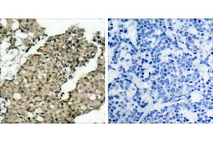 P-Peptide - +Immunohistochemical analysis of paraffin-embedded human breast carcinoma tissue using G3BP-1 (phospho-Ser232) antibody. (G3BP1 antibody  (pSer232))