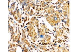Anti-Bid Picoband antibody,  IHC(P): Human Mammary Cancer Tissue (BID antibody  (AA 1-195))