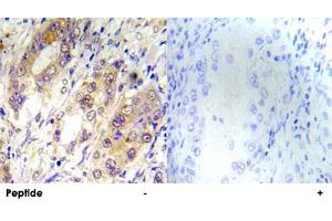 Immunohistochemical analysis of paraffin-embedded human lung carcinoma tissue using TSC2 (phospho Thr1462) polyclonal antibody . (Tuberin antibody  (pThr1462))