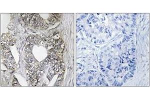 Immunohistochemistry analysis of paraffin-embedded human breast carcinoma tissue, using SAPK/JNK (Ab-183) Antibody. (SAPK, JNK (AA 166-215) antibody)