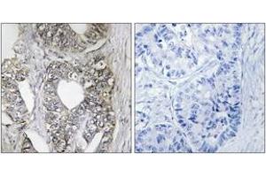 Immunohistochemistry analysis of paraffin-embedded human breast carcinoma tissue, using SAPK/JNK (Ab-183) Antibody.