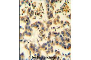 K0090 Antibody immunohistochemistry analysis in formalin fixed and paraffin embedded human testis carcinoma followed by peroxidase conjugation of the secondary antibody and DAB staining. (KIAA0090 antibody  (C-Term))