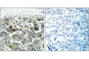Immunohistochemistry analysis of paraffin-embedded human breast carcinoma tissue, using NF-kappaB p105/p50 (Ab-907) Antibody.