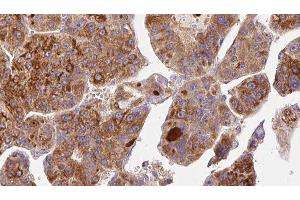 ABIN6277026 at 1/100 staining Human liver cancer tissue by IHC-P. (CD73 antibody  (N-Term))