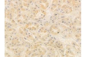 ABIN7095046 and ABIN7099102 at 1/100 staining human renal cell carcinoma by IHC-P. (FOXN3 antibody)