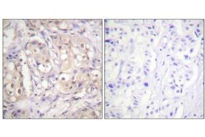 Immunohistochemical analysis of paraffin-embedded human breast carcinoma tissue using B-Raf (Phospho-Thr598) antibody (left)or the same antibody preincubated with blocking peptide (right). (BRAF antibody  (pThr599))