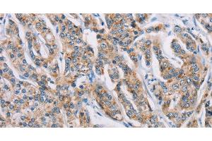 Immunohistochemistry of paraffin-embedded Human prostate cancer tissue using ATP2C1 Polyclonal Antibody at dilution 1:50 (ATP2C1 antibody)