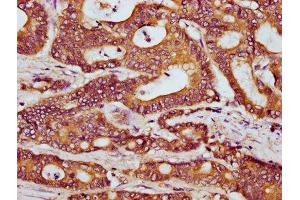 IHC image of ABIN7165641 diluted at 1:300 and staining in paraffin-embedded human colon cancer performed on a Leica BondTM system. (HOOK3 antibody  (AA 357-455))