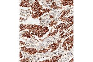 Immunohistochemical analysis of paraffin-embedded Human breast carcinoma tissue using E performed on the Leica® BOND RXm. (ErbB2/Her2 antibody)