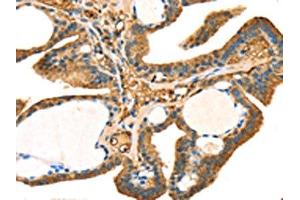 The image on the left is immunohistochemistry of paraffin-embedded Human thyroid cancer tissue using ABIN7131239(STX18 Antibody) at dilution 1/25, on the right is treated with fusion protein. (Syntaxin 18 antibody)
