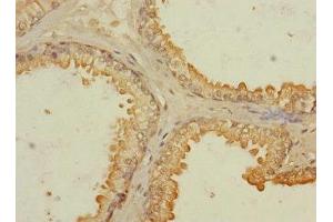 Immunohistochemistry of paraffin-embedded human prostate cancer using ABIN7167139 at dilution of 1:100 (RASSF6 antibody  (AA 1-303))
