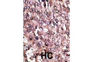 Formalin-fixed and paraffin-embedded human cancer tissue reacted with the primary antibody, which was peroxidase-conjugated to the secondary antibody, followed by AEC staining. (MAGEC1 antibody  (C-Term))