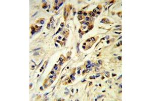 Human breast carcinoma (formalin-fixed, paraffin-embedded) reacted with IL10 Antibody , which was peroxidase-conjugated to the secondary antibody, followed by DAB staining. (IL-10 antibody  (Middle Region))