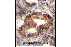 RAB3D Antibody (C-term) (ABIN657140 and ABIN2846278) immunohistochemistry analysis in formalin fixed and paraffin embedded human prostate carcinoma followed by peroxidase conjugation of the secondary antibody and DAB staining. (RAB3D antibody  (C-Term))