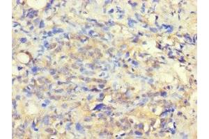 Immunohistochemistry of paraffin-embedded human gastric cancer using ABIN7175332 at dilution of 1:100 (VTA1 antibody  (AA 23-307))