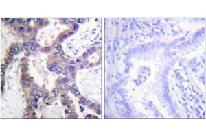 Immunohistochemistry analysis of paraffin-embedded human lung carcinoma, using MKP1 (Phospho-Ser359) Antibody. (DUSP1 antibody  (pSer359))