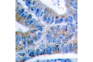 Immunohistochemical analysis of BCLX (pS62) staining in human colon cancer formalin fixed paraffin embedded tissue section. (BCL2L1 antibody  (pSer62))