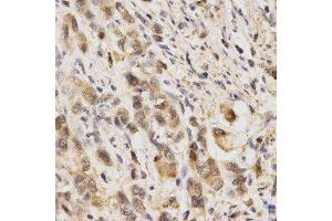Immunohistochemistry of paraffin-embedded human stomach cancer using NFE2L2 antibody at dilution of 1:200 (x400 lens) (NRF2 antibody  (AA 366-605))