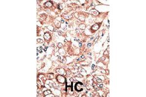 Formalin-fixed and paraffin-embedded human hepatocellular carcinoma tissue reacted with GJB2 polyclonal antibody  , which was peroxidase-conjugated to the secondary antibody, followed by DAB staining. (GJB2 antibody  (C-Term))
