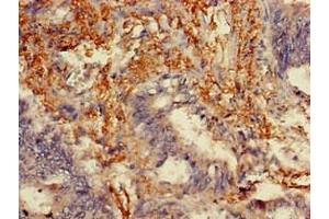 Immunohistochemistry of paraffin-embedded human colon cancer using ABIN7159304 at dilution of 1:100 (Melanophilin antibody  (AA 310-539))