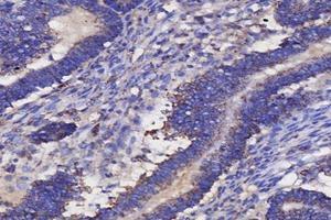 Immunohistochemistry analysis of paraffin-embedded human ovarian cancer using IL-3RB (ABIN7073557) at dilution of 1: 4000 (CD131 antibody)