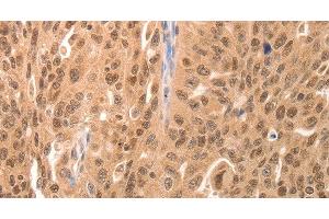 Immunohistochemistry of paraffin-embedded Human breast cancer tissue using JUND Polyclonal Antibody at dilution 1:60 (JunD antibody)