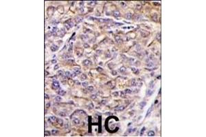 Formalin-fixed and paraffin-embedded human hepatocarcinoma tissue reacted with TAOK3 antibody (C-term) (ABIN390997 and ABIN2841175) , which was peroxidase-conjugated to the secondary antibody, followed by DAB staining.