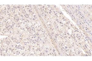Detection of MBP in Human Liver cancer Tissue using Monoclonal Antibody to Major Basic Protein (MBP) (Major Basic Protein antibody  (AA 105-222))