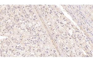 Detection of MBP in Human Liver cancer Tissue using Monoclonal Antibody to Major Basic Protein (MBP)