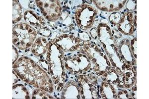 Immunohistochemical staining of paraffin-embedded Carcinoma of liver tissue using anti-LIPG mouse monoclonal antibody. (LIPG antibody)
