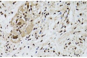 Immunohistochemistry of paraffin-embedded Human colon carcinoma using LKB1 Polyclonal Antibody at dilution of 1:100 (40x lens). (LKB1 antibody)