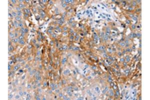 The image on the left is immunohistochemistry of paraffin-embedded Human lung cancer tissue using ABIN7130650(PLCZ1 Antibody) at dilution 1/25, on the right is treated with fusion protein. (PLCz1 antibody)