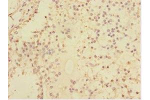 Immunohistochemistry of paraffin-embedded human breast cancer using ABIN7170630 at dilution of 1:100 (Splicing factor U2AF 26 kDa subunit (U2AF1L4) (AA 1-202) antibody)