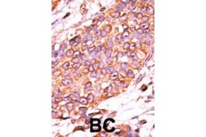 Formalin-fixed and paraffin-embedded human cancer tissue reacted with the primary antibody, which was peroxidase-conjugated to the secondary antibody, followed by AEC staining. (DUSP13-L184 (AA 169-198), (C-Term) antibody)