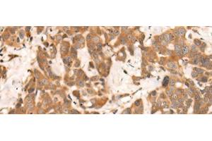 Immunohistochemistry of paraffin-embedded Human thyroid cancer tissue using NRG2 Polyclonal Antibody at dilution of 1:65(x200) (Neuregulin 2 antibody)