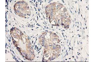 Immunohistochemical staining of paraffin-embedded Adenocarcinoma of Human breast tissue using anti-EIF2B3 mouse monoclonal antibody. (EIF2B3 antibody)