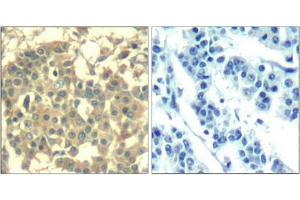 Immunohistochemical analysis of paraffin-embedded human breast carcinoma tissue using Met(Ab-1003) Antibody(left) or the same antibody preincubated with blocking peptide(right). (c-MET antibody  (AA 1001-1005))